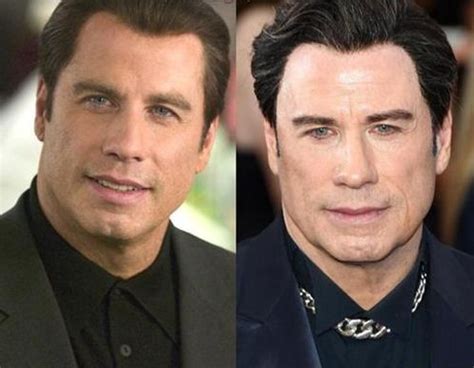 John Travolta Before and After Plastic Surgery